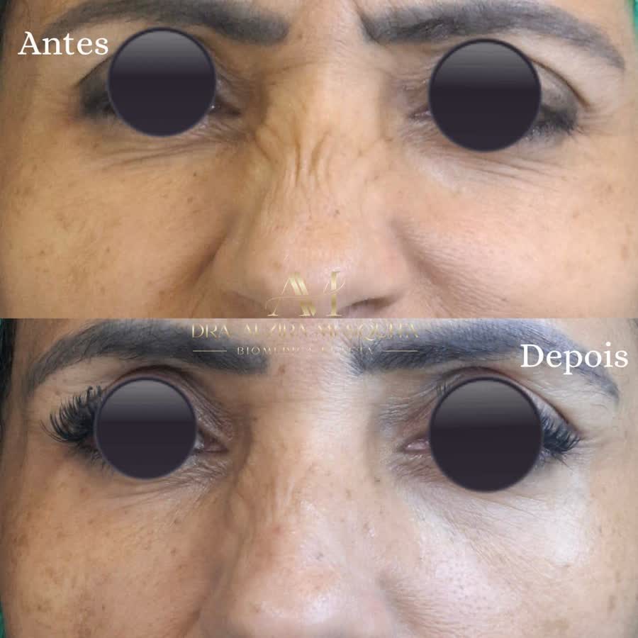 Resultado antes e depois 10
