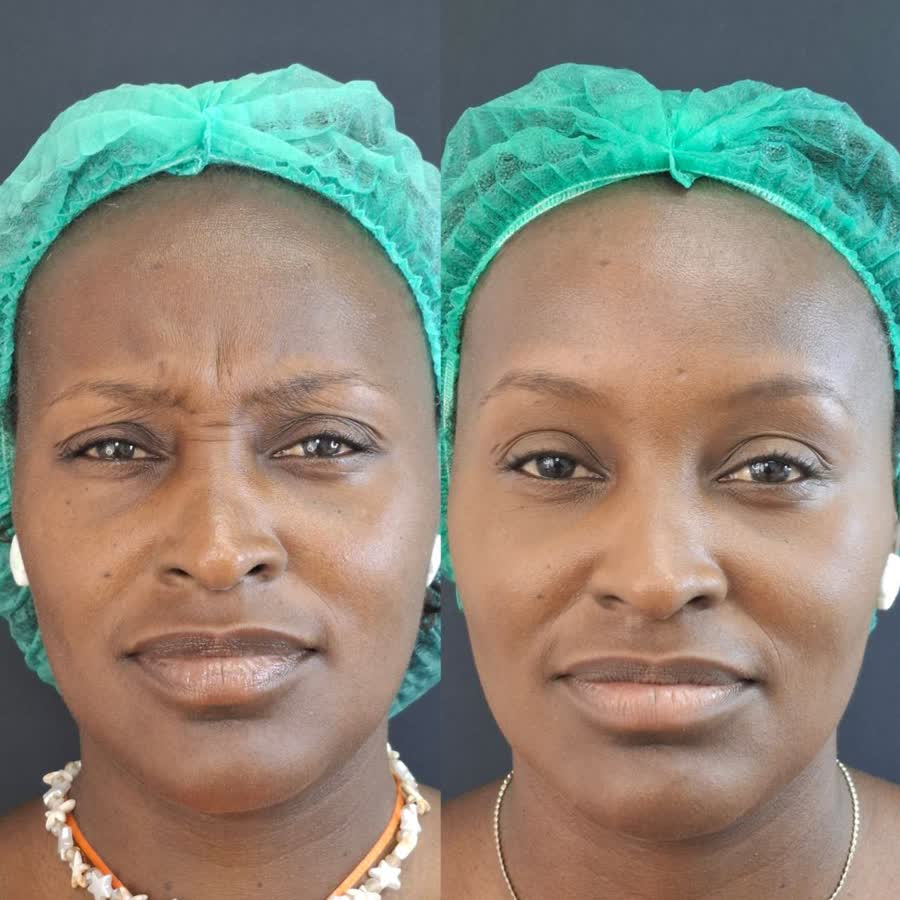 Resultado antes e depois 2