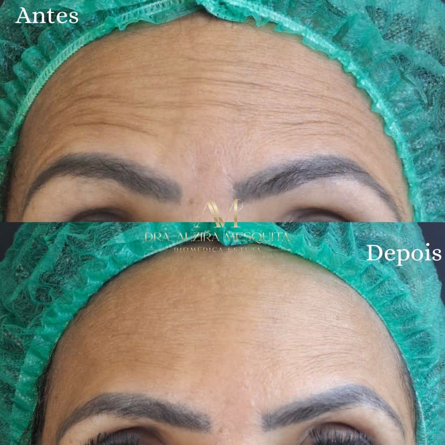 Resultado antes e depois 3