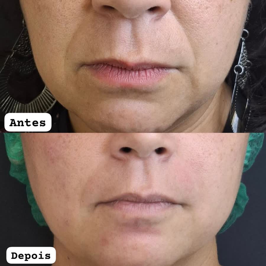 Resultado antes e depois 4