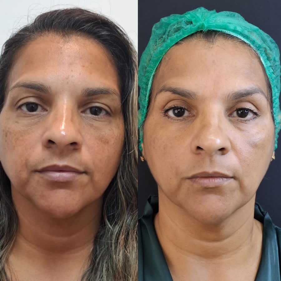 Resultado antes e depois 5