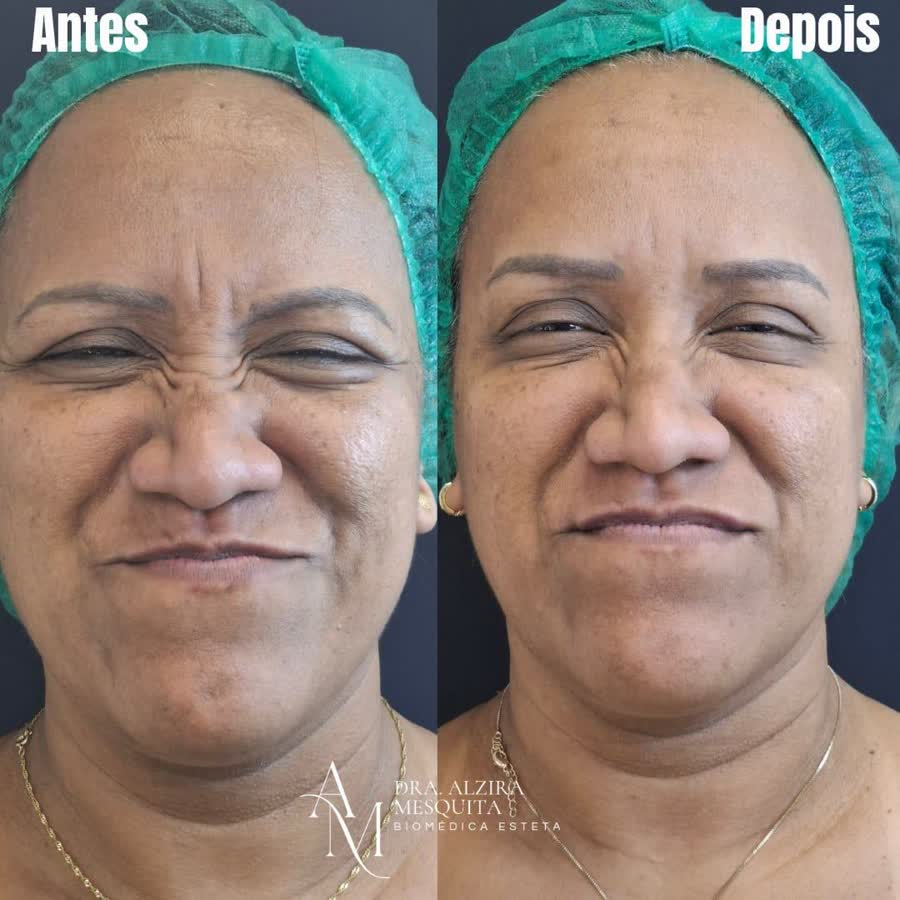 Resultado antes e depois 6