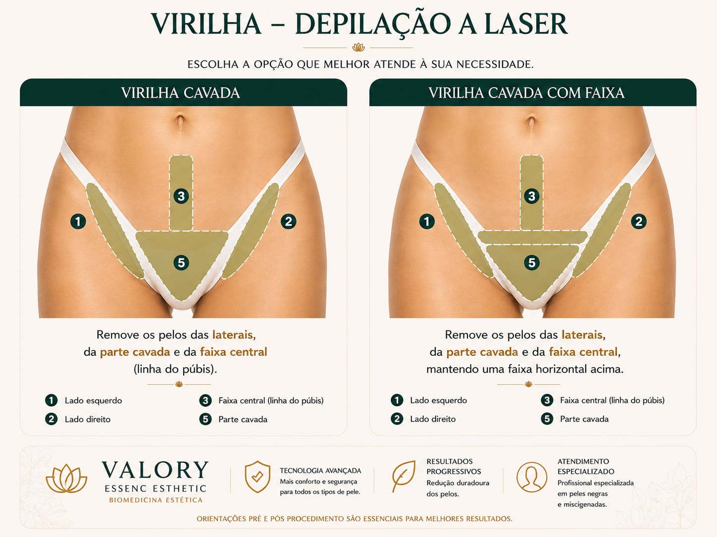 Guia de depilação a laser: Virilha cavada